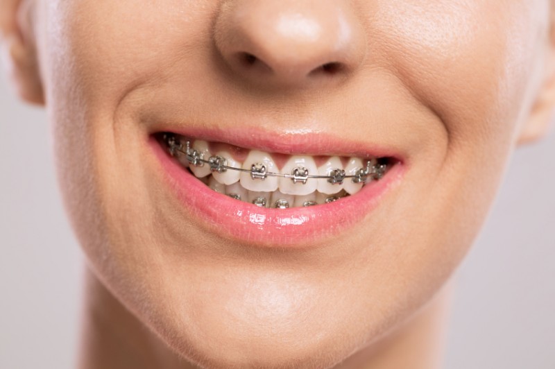 what are the advantages of fastbraces over traditional braces