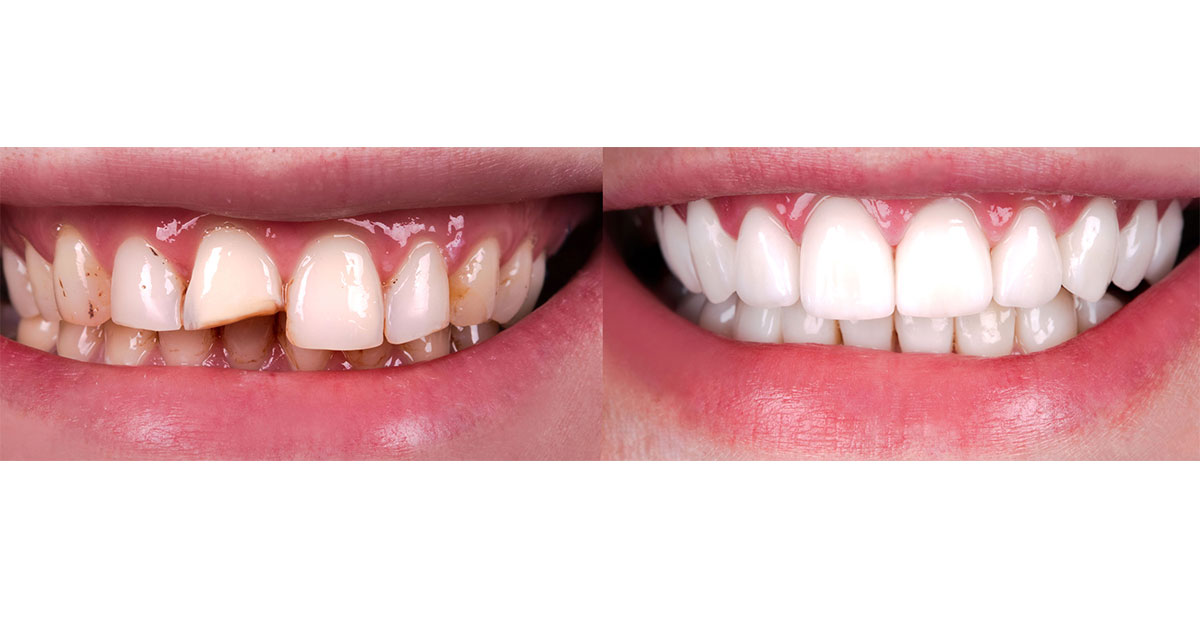 Visual examples of before and after treatment for lost fillings