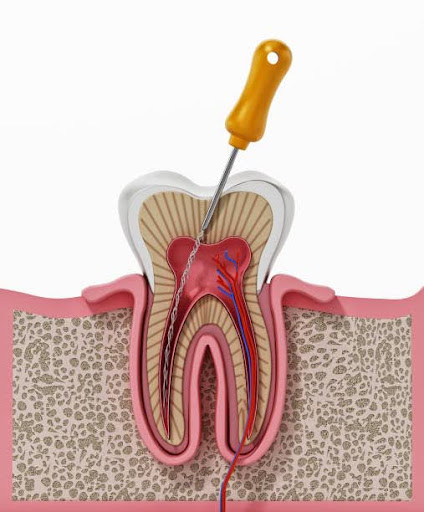 3D illustration of root canal treatment process.