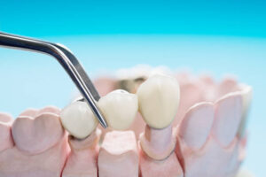 Closeup / Prosthodontics or Prosthetic / Teeth