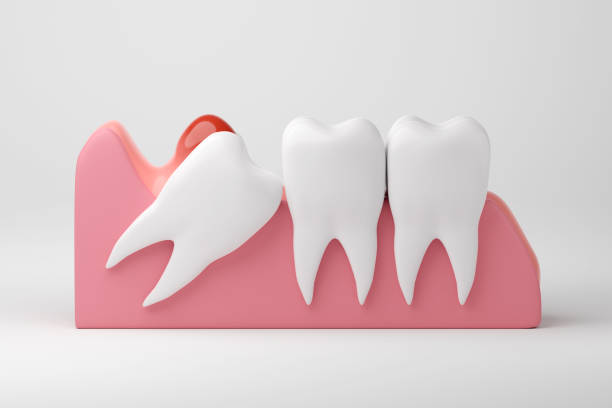 Wisdom tooth infection and inflammation gums on white background, 3D rendering.