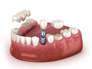 Tooth recovery with implant crown and bridge