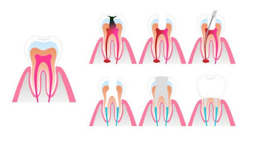Root canal treatment image