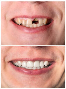 Incisive man's tooth restoration before and after treatment