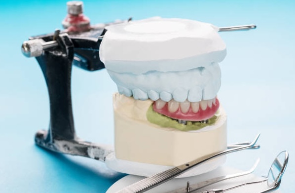 Closeup/ Dental implants supported overdenture on blue background.