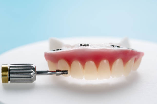 Closeup/ Dental implants