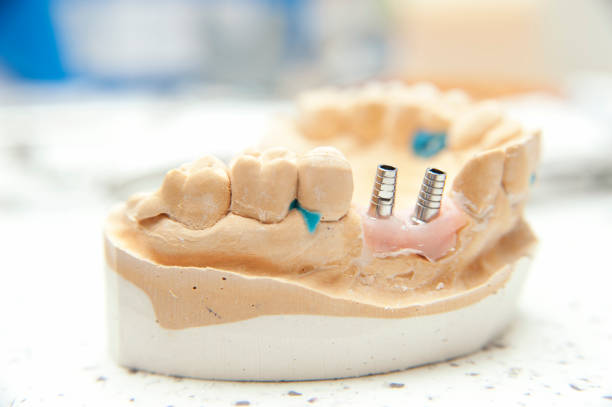 Closeup/ Dental implants supported overdenture on blue background.