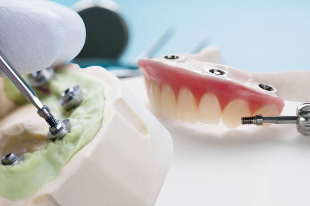Closeup/ Dental implants supported overdenture on blue background.