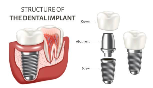 02-implant-diagram